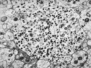 M,3y. | neuroblastoma - adrenal M,3y. | neuroblastoma - adrenal